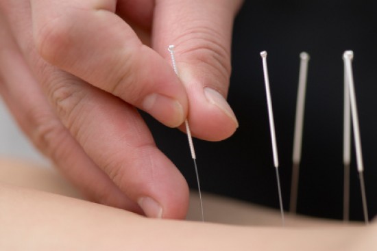 Az akupunktúra valóban enyhíti a krónikus fájdalmat