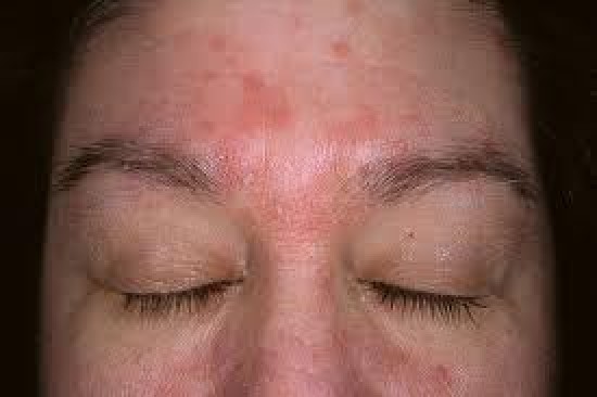Bőrbetegségek - Seborrheás dermatitis