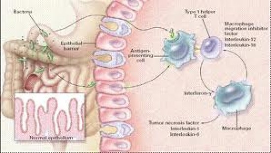 Emésztőrendszeri megbetegedések - Crohn-betegség