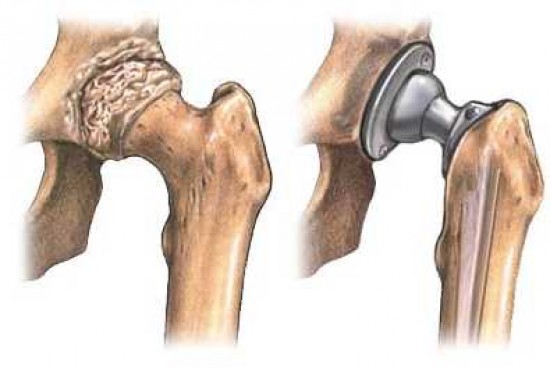 Ortopédia - Csípőprotézis