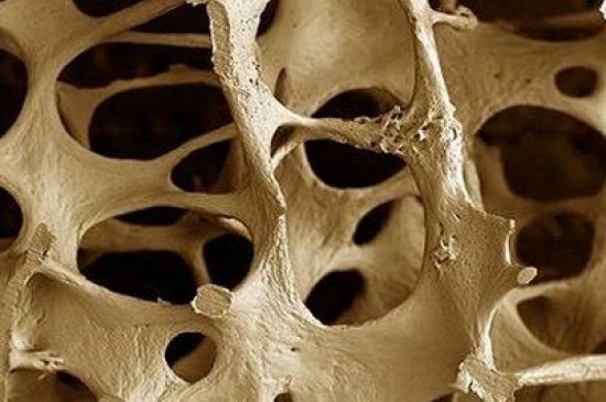 Reumatológiai megbetegedések - Csontritkulás (Osteoporozis)