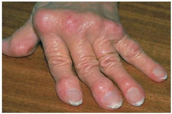 Reumatológiai megbetegedések - Reumatoid arthritis