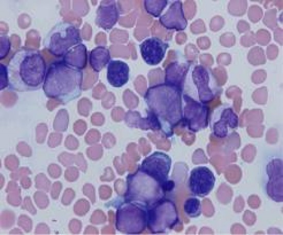 AML - acut myeloid leukaemia