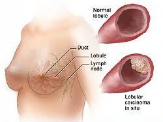 LCIS - Lobular Carcinoma In Situ