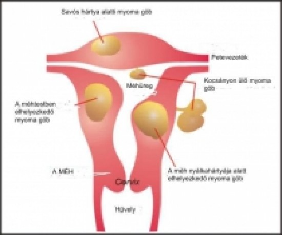 Myoma uteri - méhizomdaganat