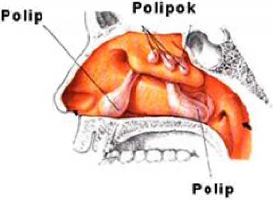 Polipektómia