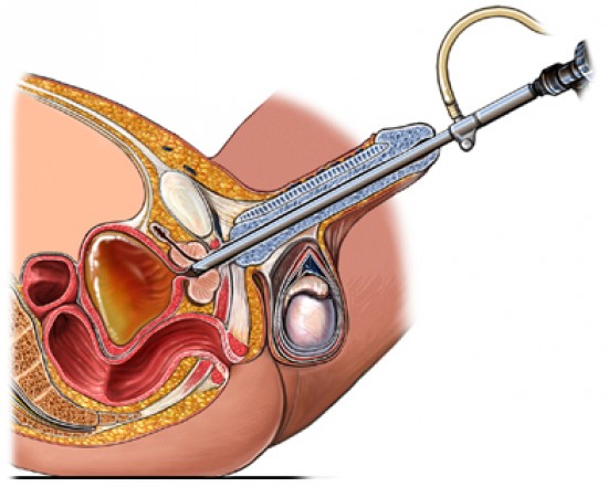 TURP - Transurethal Resection of the Prostate