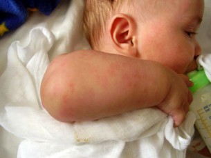 A babaallergia gyanúja