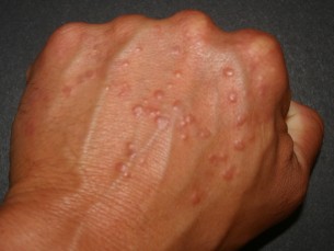  Szörnyű bőrbetegség, ami vissza is térhet - a granuloma anulare