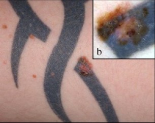  Veszélyes minták: Tetoválás és súlyos bőrbetegség