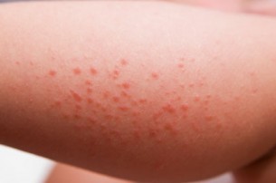 Csalánkiütés - nem csak allergia okozhatja