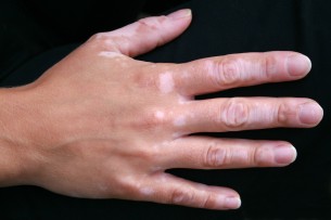 Fehér foltok? Nem mind vitiligo