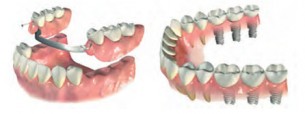 Fogpótlás: Így nem rongálják az egészséges fogat