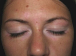 Ilyen a vitiligo - az arcon jelentkező pigmenthiány