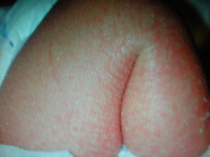 Ízületi fájdalmak bőrbetegségtől - Így segít a biológiai terápia