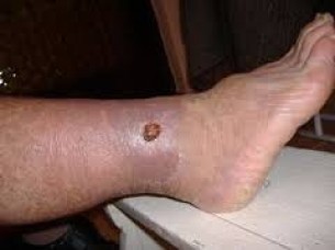Lábra kap a fájdalom: Borzasztó lábszárfekélyhez vezethet az elhanyagolt v