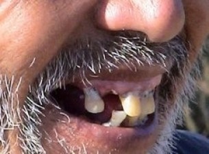 Mit lehet kezdeni egy-két foggal?
