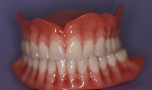 Újfajta protézis - Kivehető fogsor, amely mégis szorosan zár